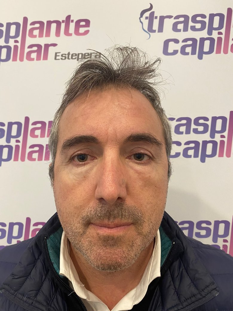 Antes del injerto capilar DHI: entradas y línea frontal despoblada — paciente de ESTEPERA