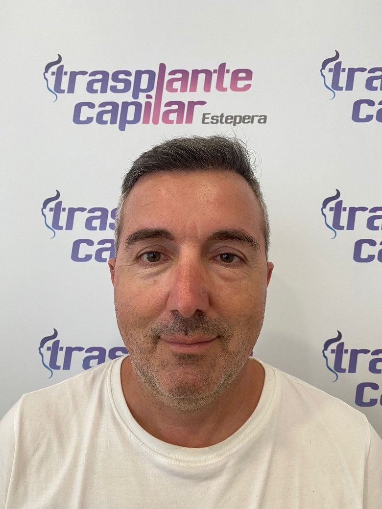 Resultado del injerto capilar DHI a 1 año: línea frontal recuperada con aspecto natural, 4.000 injertos — paciente de ESTEPERA