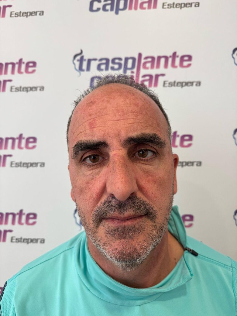 Antes del injerto capilar DHI: pérdida en la línea frontal y la coronilla — paciente de ESTEPERA