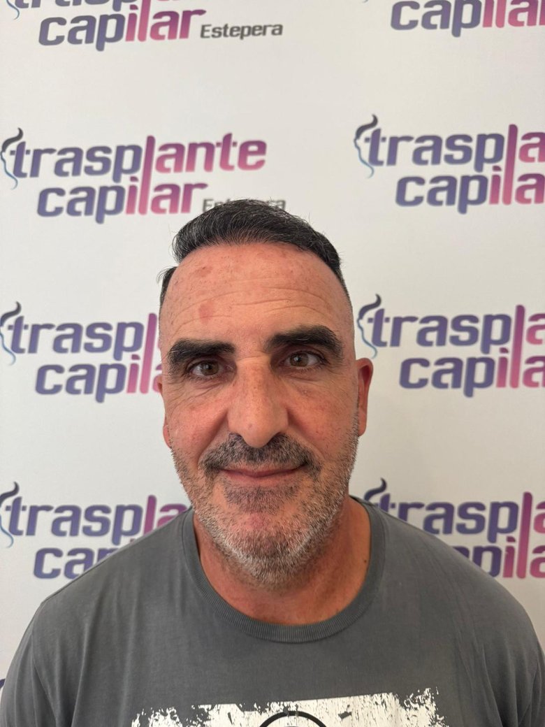 Después del injerto capilar DHI a los 6 meses: densidad recuperada con resultado natural, 4.400 injertos — paciente de ESTEPERA
