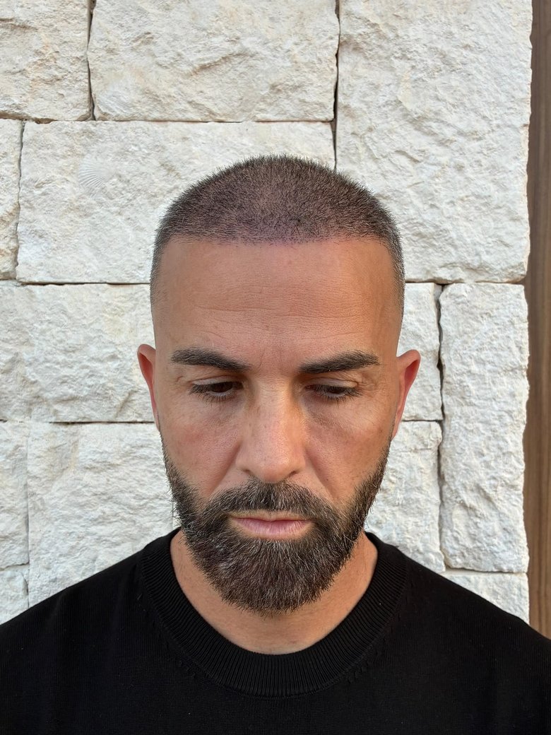 Injerto capilar DHI a los 15 días: línea frontal implantada con 4.500 injertos, tras caerse las costras — postoperatorio de un paciente de ESTEPERA